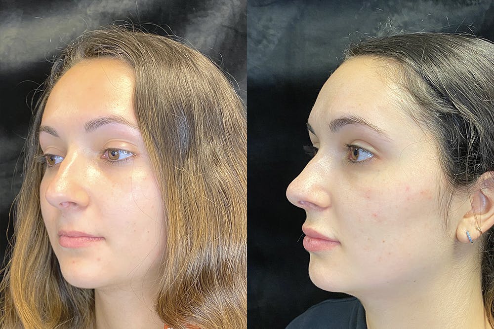 Dermal Fillers Before & After Gallery - Patient 120816839 - Image 4