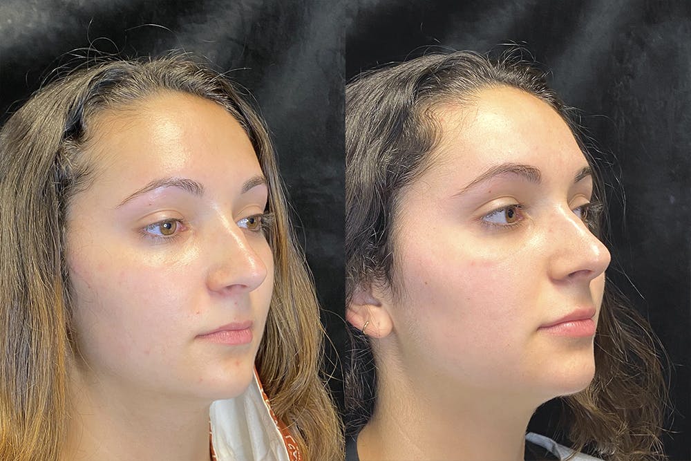 Dermal Fillers Before & After Gallery - Patient 120816839 - Image 5