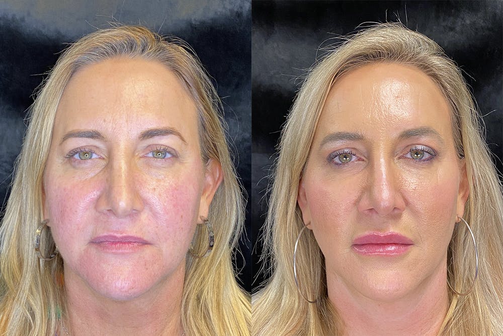 Dermal Fillers Before & After Gallery - Patient 120902870 - Image 1