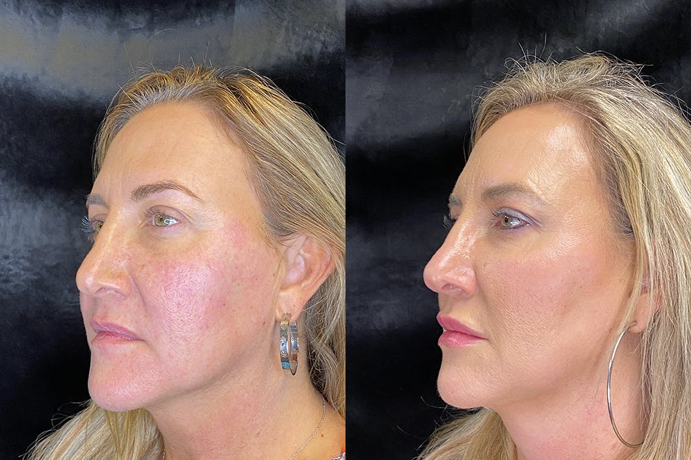 BOTOX/Dysport Before & After Gallery - Patient 120902871 - Image 2