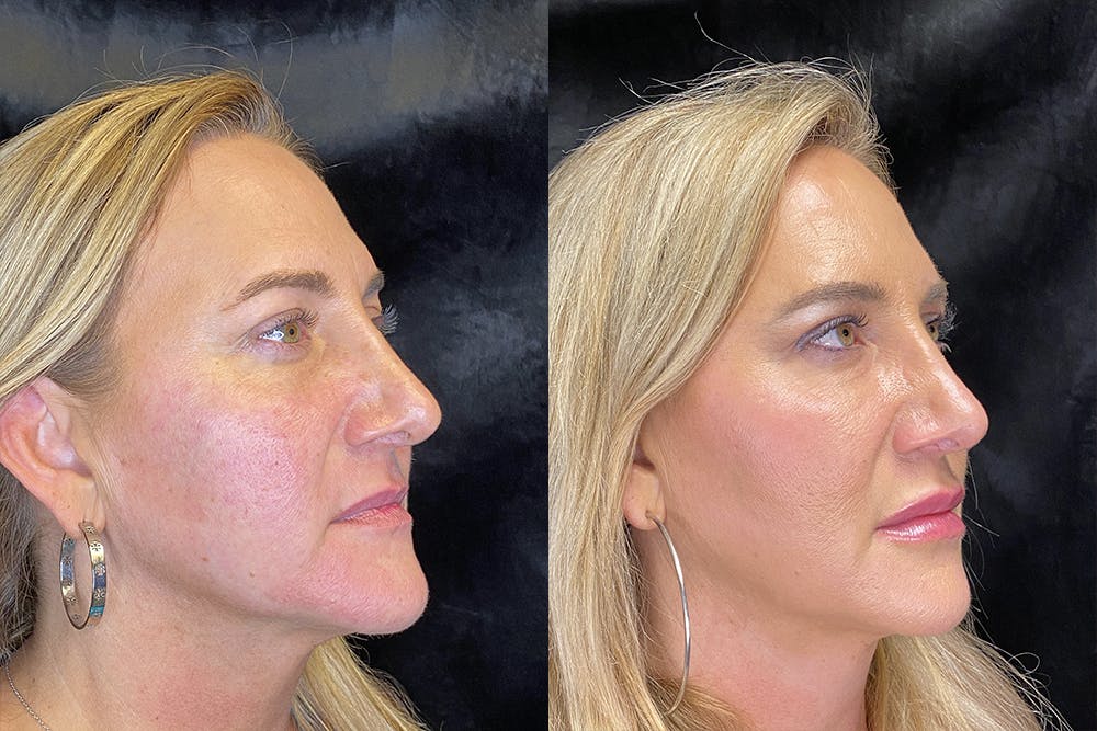BOTOX/Dysport Before & After Gallery - Patient 120902871 - Image 3