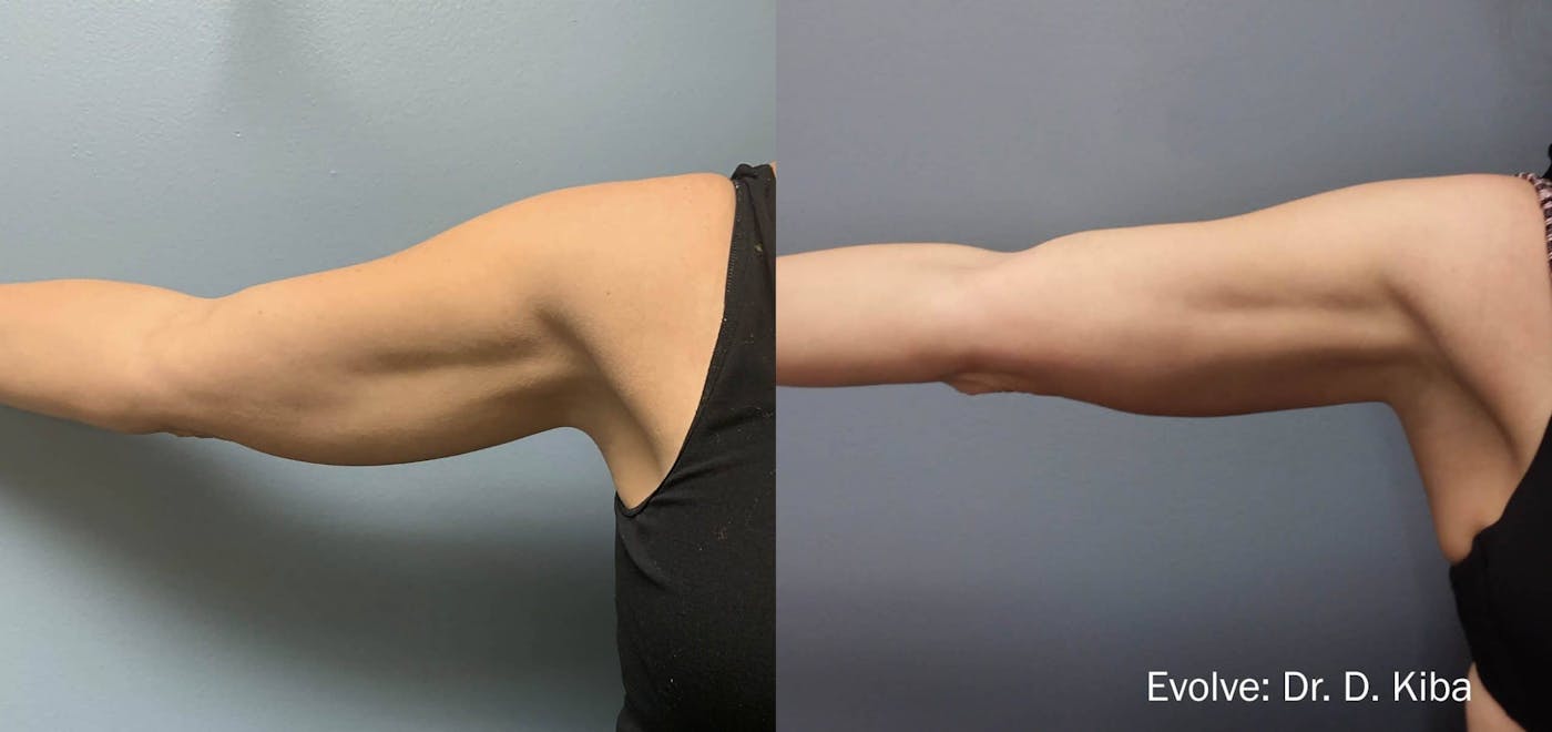 Before and after EvolveX at Modern Women's Health