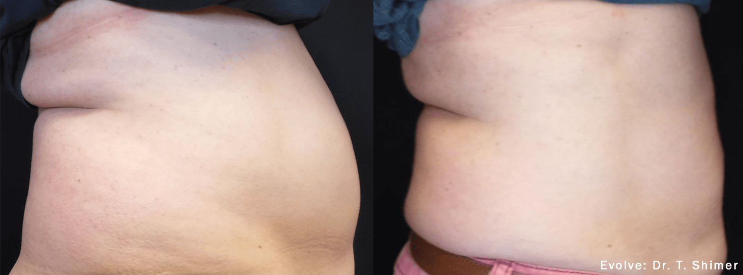 EvolveX Before & After Gallery - Patient 121120367 - Image 1