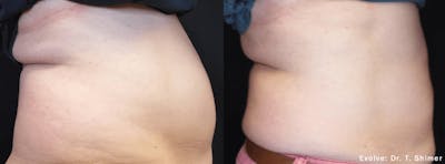 EvolveX Before & After Gallery - Patient 121120367 - Image 1