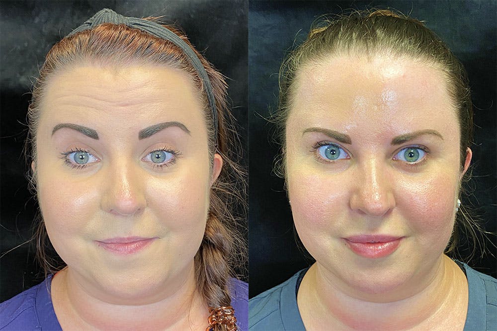 Dermal Fillers Before & After Gallery - Patient 121667588 - Image 1