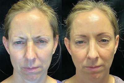 BOTOX/Dysport Before & After Gallery - Patient 121980485 - Image 1