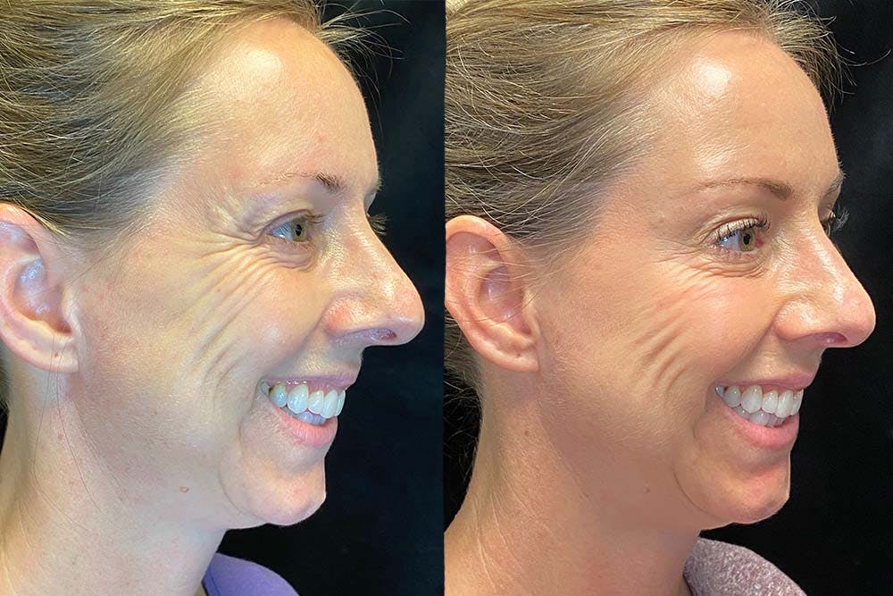 BOTOX/Dysport Before & After Gallery - Patient 121980485 - Image 3