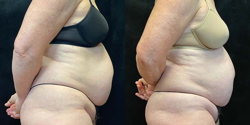 EvolveX Before & After Gallery - Patient 154143624 - Image 3