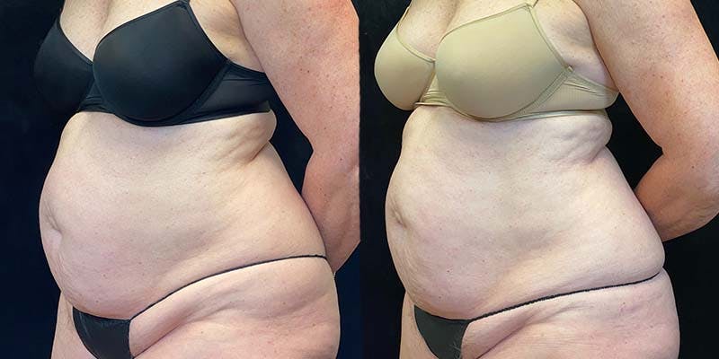 EvolveX Before & After Gallery - Patient 154143624 - Image 4