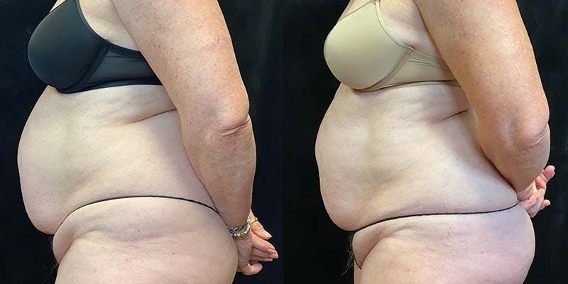 EvolveX Before & After Gallery - Patient 154143624 - Image 5