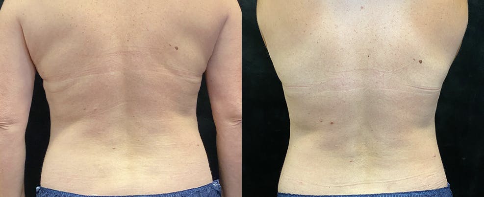 SculpSure Before & After Gallery - Patient 122286347 - Image 1