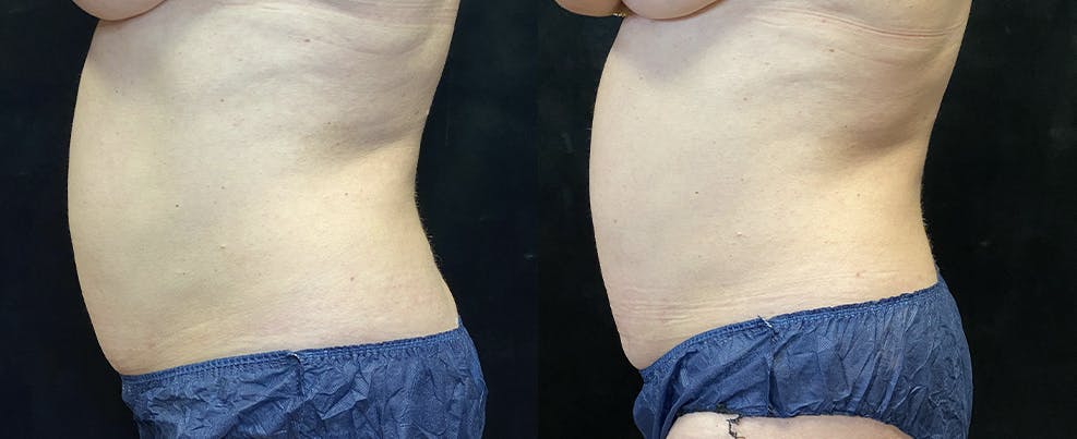 SculpSure Before & After Gallery - Patient 122286347 - Image 2