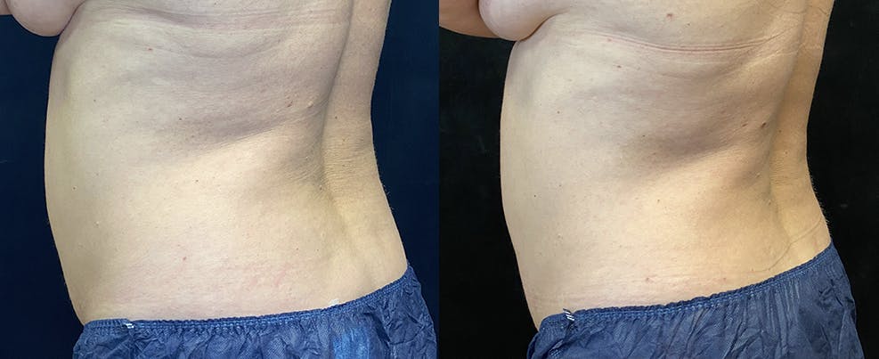 SculpSure Before & After Gallery - Patient 122286347 - Image 3