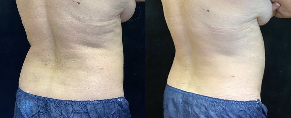 SculpSure Before & After Gallery - Patient 122286347 - Image 4