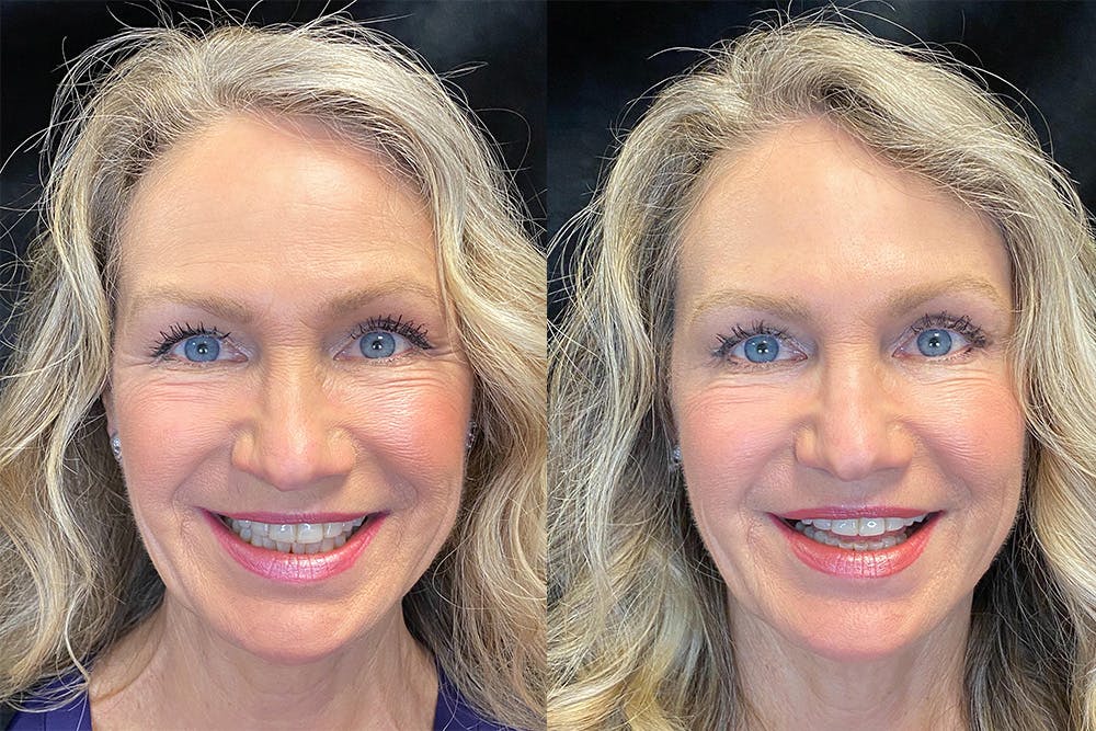 BOTOX/Dysport Before & After Gallery - Patient 122622855 - Image 1