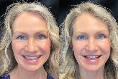 BOTOX/Dysport Before & After Gallery - Patient 122622855 - Image 1