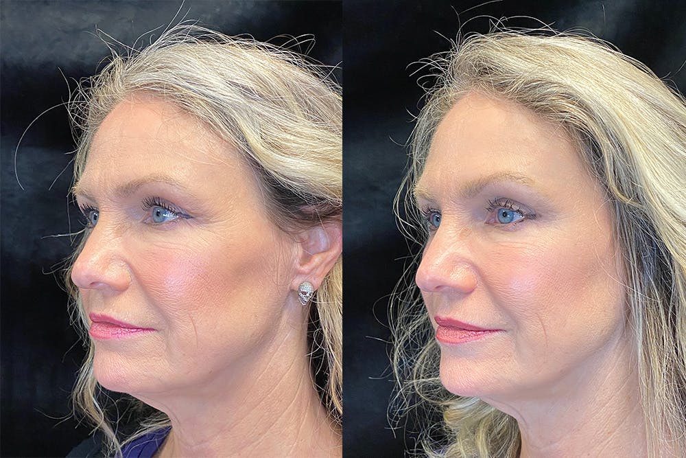 BOTOX/Dysport Before & After Gallery - Patient 122622855 - Image 2