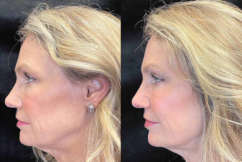 BOTOX/Dysport Before & After Gallery - Patient 122622855 - Image 3