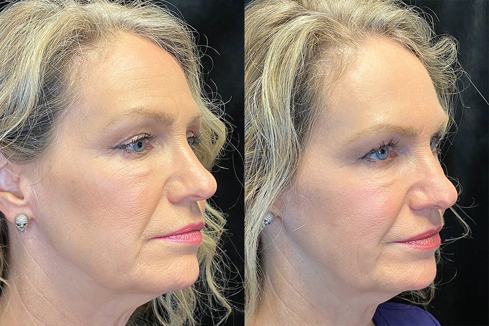 BOTOX/Dysport Before & After Gallery - Patient 122622855 - Image 4
