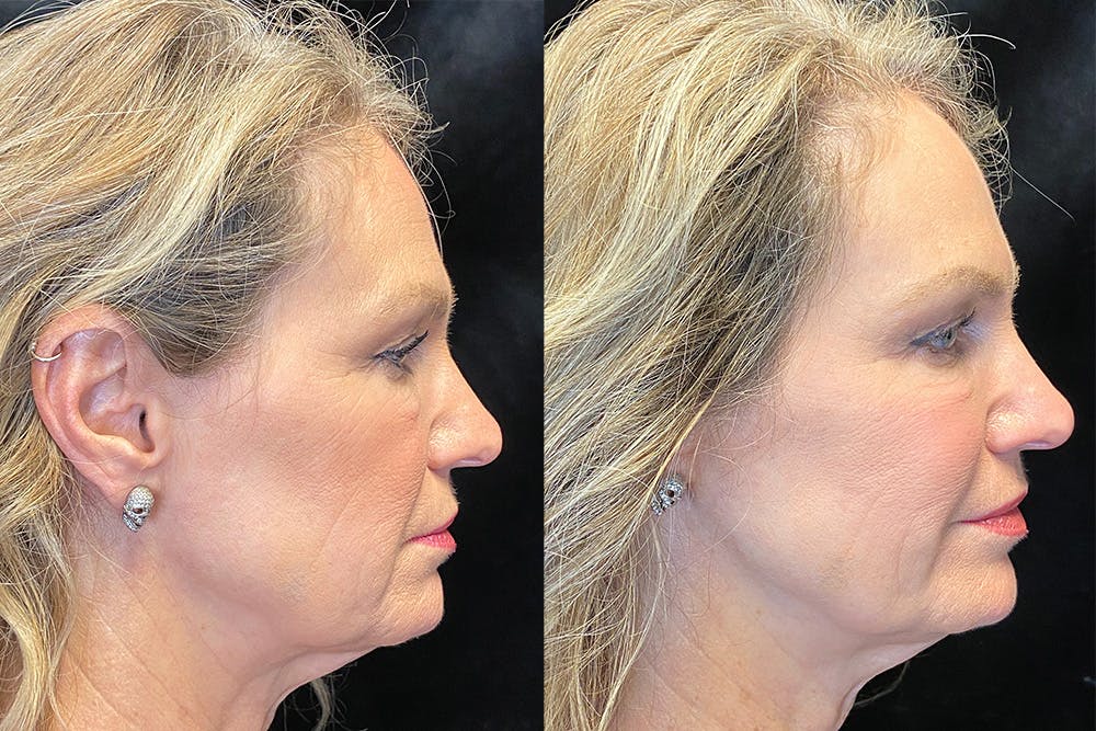BOTOX/Dysport Before & After Gallery - Patient 122622855 - Image 5