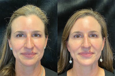 Dermal Fillers Before & After Gallery - Patient 123065709 - Image 1