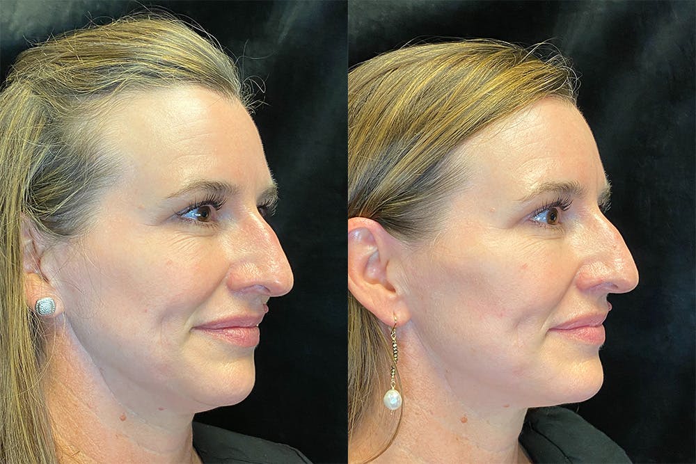 Dermal Fillers Before & After Gallery - Patient 123065709 - Image 2