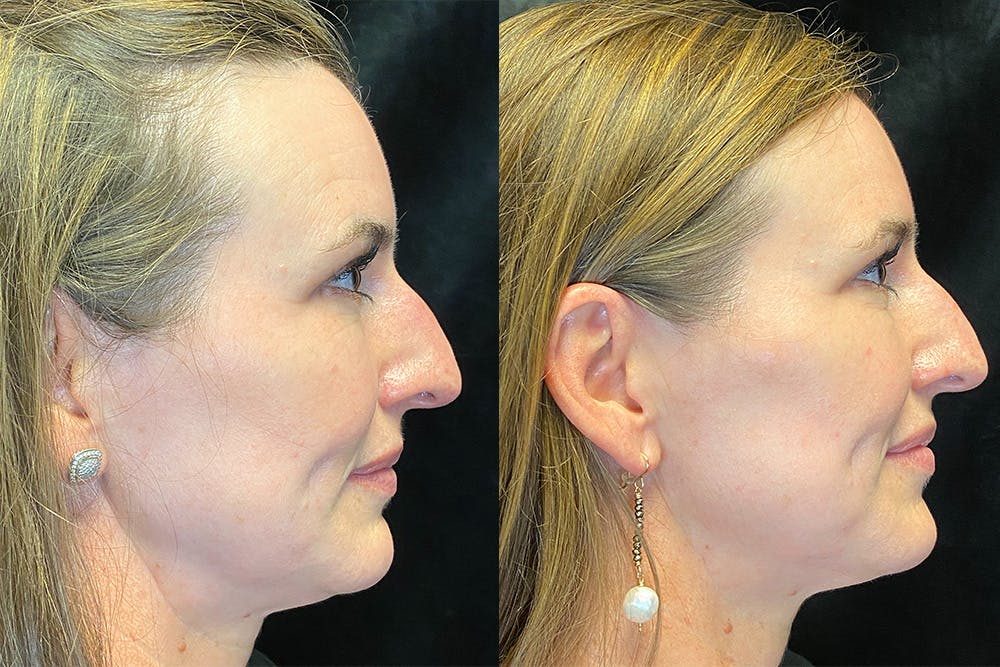 BOTOX/Dysport Before & After Gallery - Patient 123065715 - Image 3