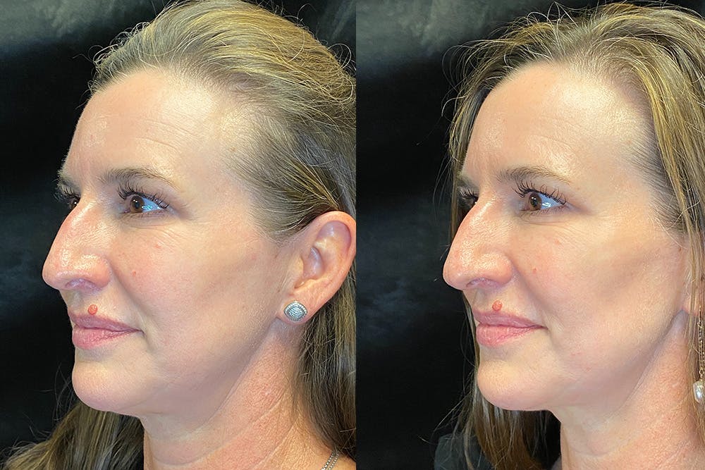 BOTOX/Dysport Before & After Gallery - Patient 123065715 - Image 4
