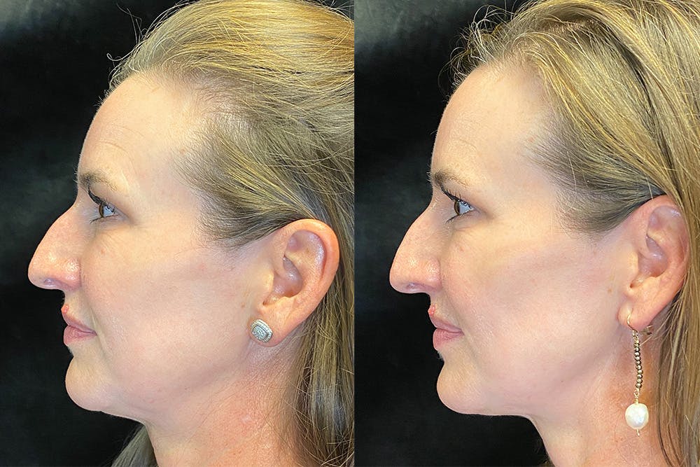BOTOX/Dysport Before & After Gallery - Patient 123065715 - Image 5