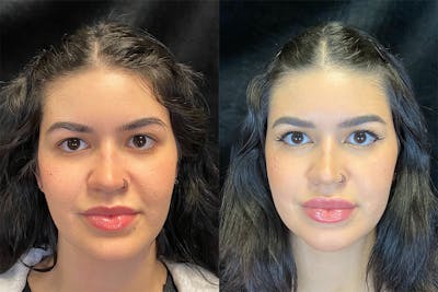 BOTOX/Dysport Before & After Gallery - Patient 123065717 - Image 1