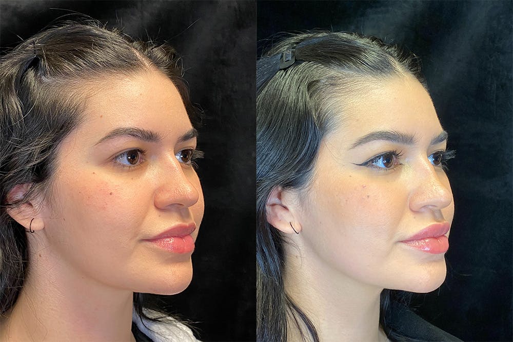 BOTOX/Dysport Before & After Gallery - Patient 123065717 - Image 2