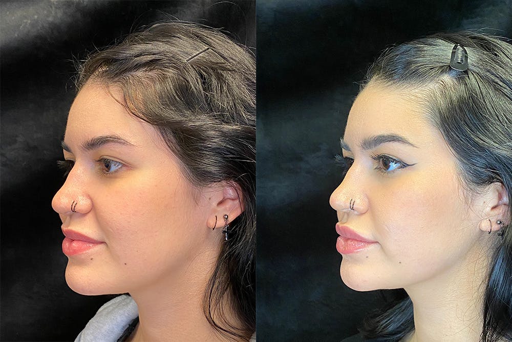 BOTOX/Dysport Before & After Gallery - Patient 123065717 - Image 3