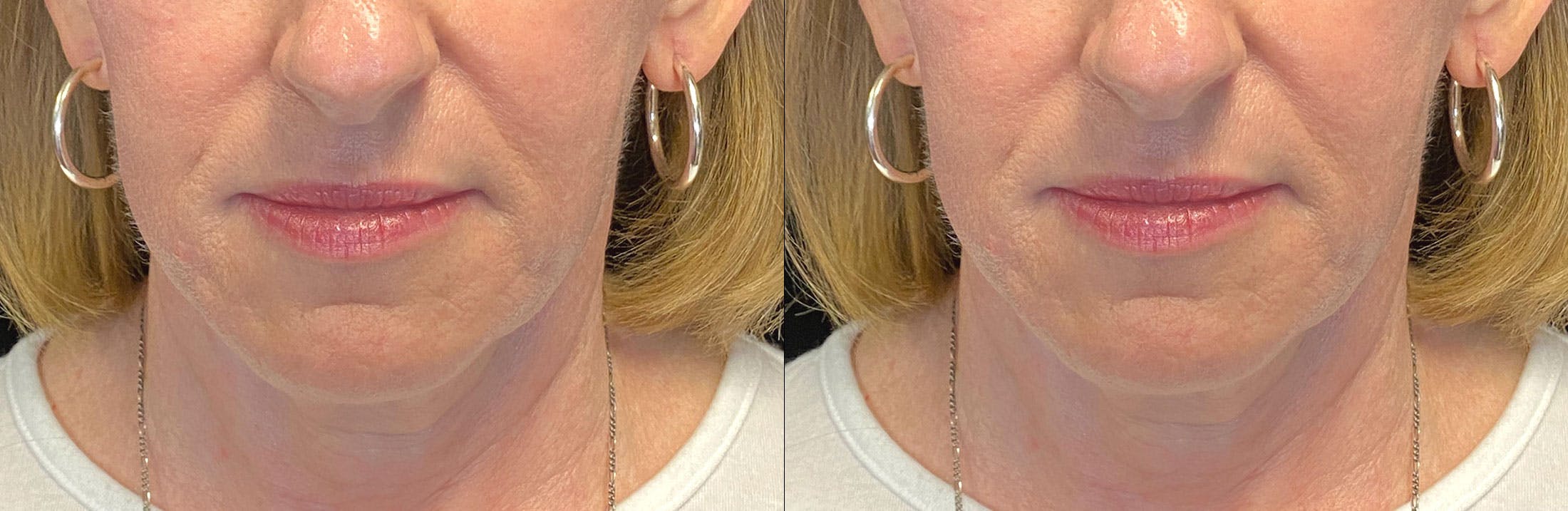 Dermal Fillers Before & After Gallery - Patient 141159977 - Image 1
