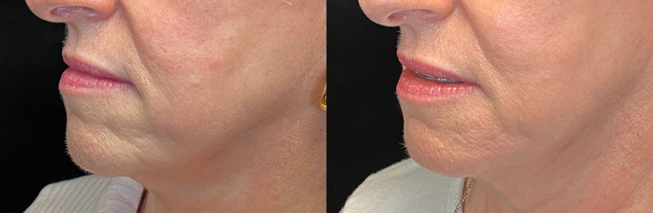 Dermal Fillers Before & After Gallery - Patient 141159977 - Image 2