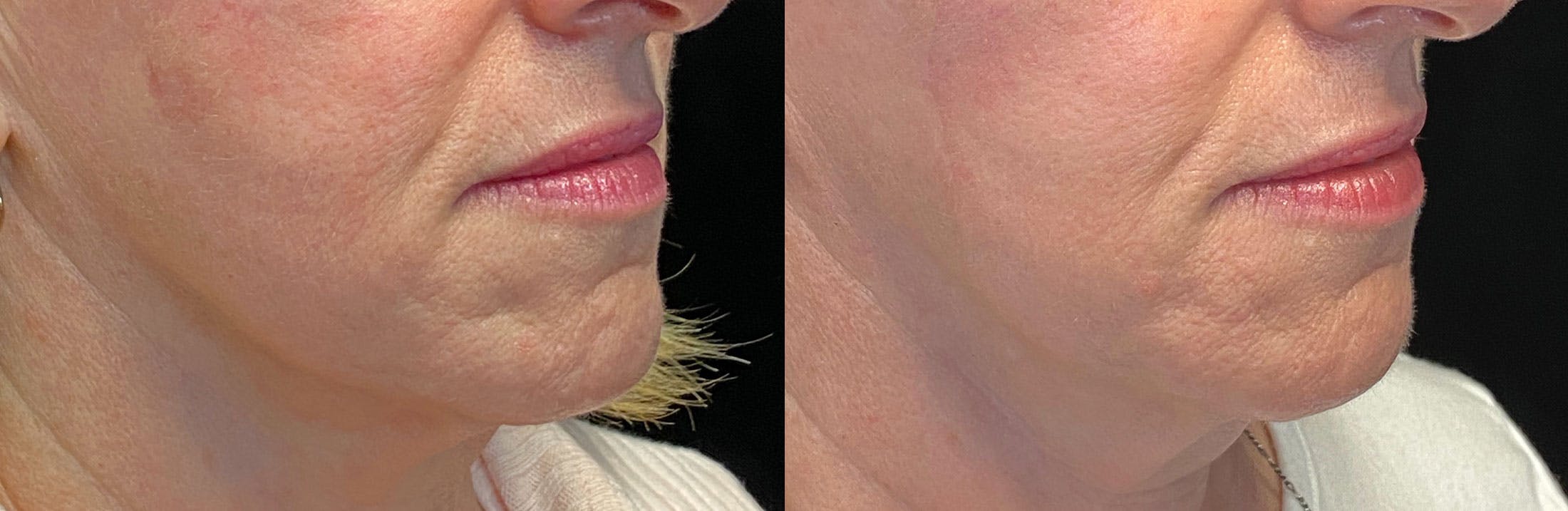 Dermal Fillers Before & After Gallery - Patient 141159977 - Image 3
