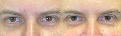 PRP Before & After Gallery - Patient 141159979 - Image 1