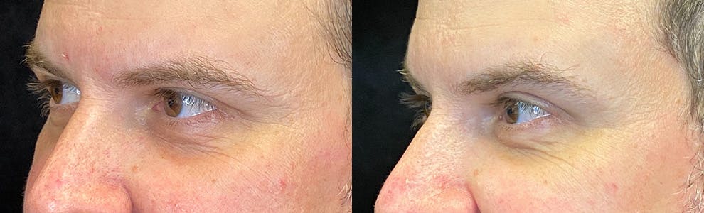 PRP Before & After Gallery - Patient 141159979 - Image 3