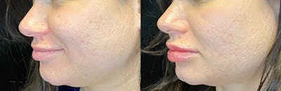 Dermal Fillers Before & After Gallery - Patient 142704102 - Image 1