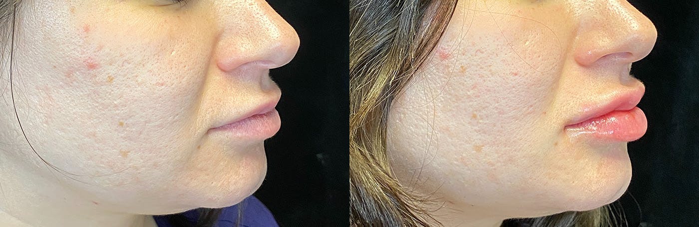 Dermal Fillers Before & After Gallery - Patient 142704102 - Image 2