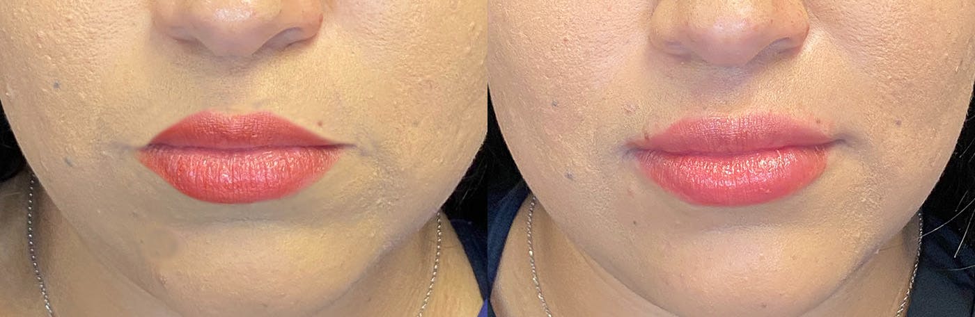 Dermal Fillers Before & After Gallery - Patient 142704103 - Image 1