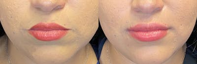 Dermal Fillers Before & After Gallery - Patient 142704103 - Image 1