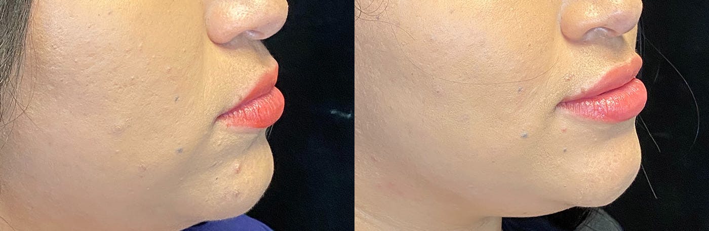 Dermal Fillers Before & After Gallery - Patient 142704103 - Image 2