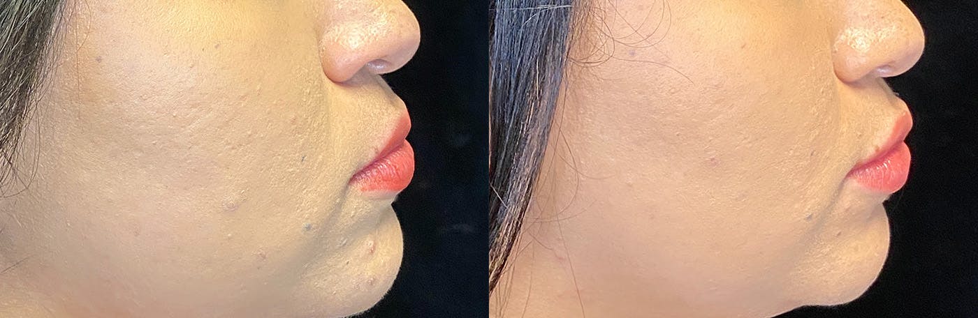 Dermal Fillers Before & After Gallery - Patient 142704103 - Image 3