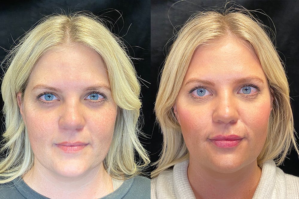 Before & after Botox in Austin at Modern Women's Health