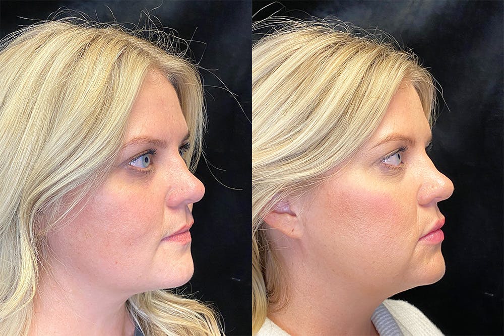 BOTOX/Dysport Before & After Gallery - Patient 143250964 - Image 2
