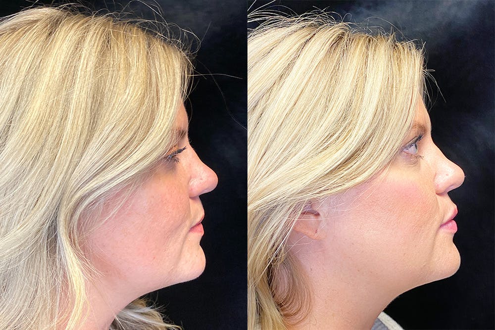 BOTOX/Dysport Before & After Gallery - Patient 143250964 - Image 3