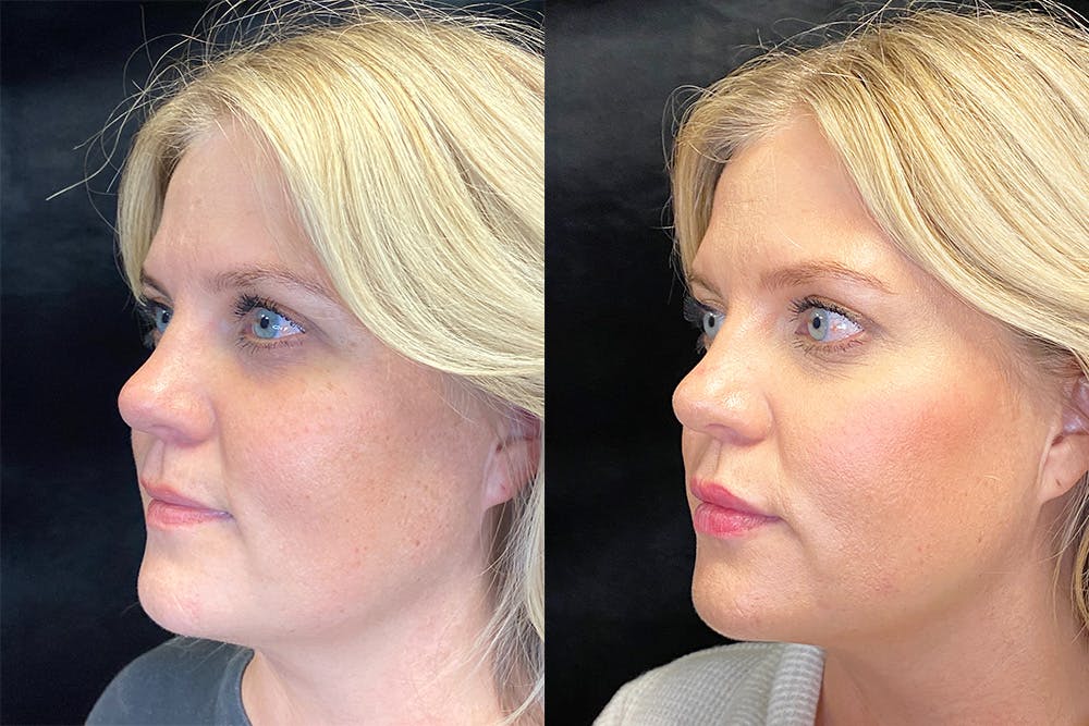 BOTOX/Dysport Before & After Gallery - Patient 143250964 - Image 4