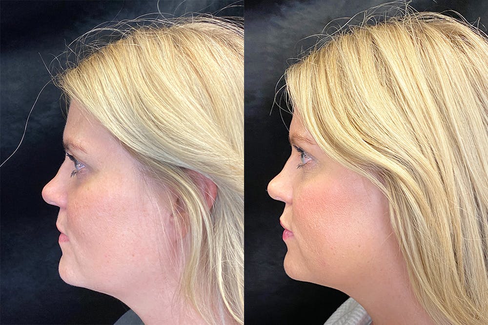 Dermal Fillers Before & After Gallery - Patient 143250965 - Image 5