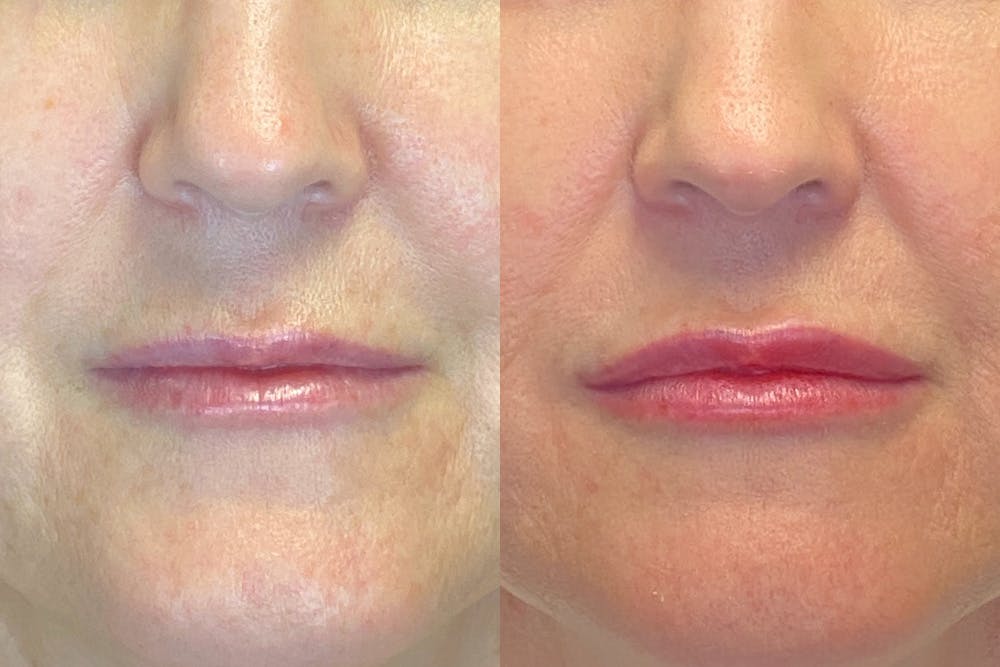 Dermal Fillers Before & After Gallery - Patient 144315044 - Image 1