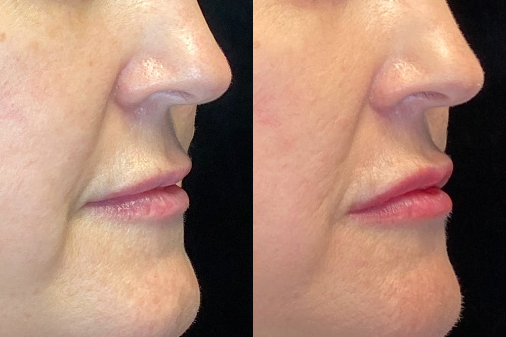 Dermal Fillers Before & After Gallery - Patient 144315044 - Image 2